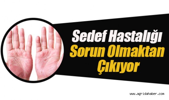 Sedef Hastalarına Müjde