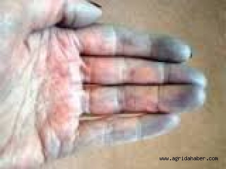 Raynaud Hastalığı