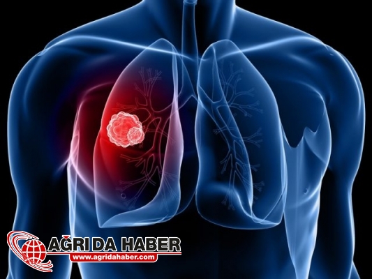 Akciğer Kanseri Hastalığında sevindiren Tedavi