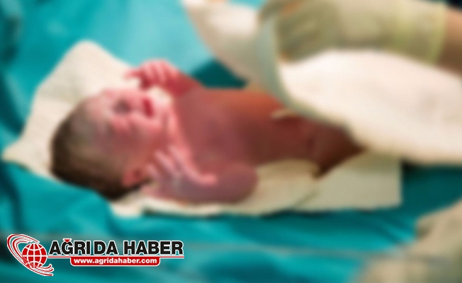 Hindistan'da Denizkızı Sendromlu Bebek 4 Saat Sonra Öldü !