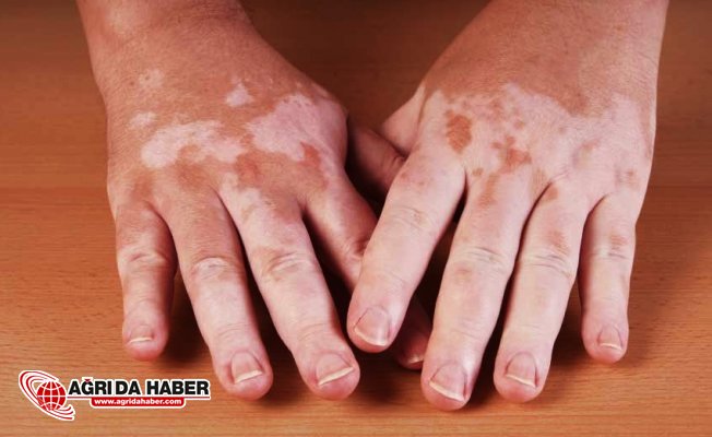 Vitiligo Hastalığı Nedir? Nasıl Tedavi Edilir?