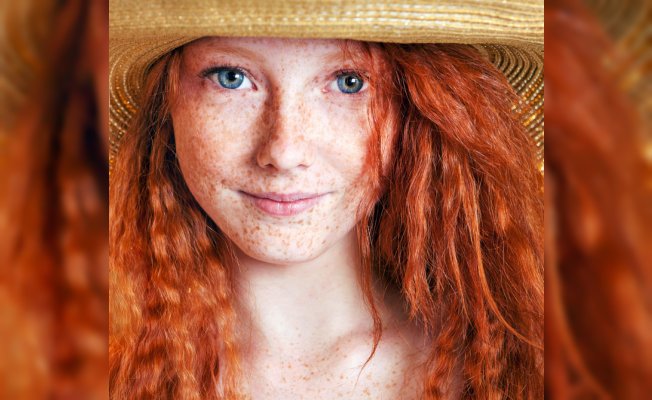 Güneş Lekesi Nedir ? Çözümü Nelerdir ?