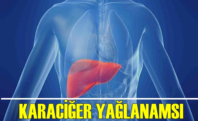 Türkiye Nüfusunun Çoğunda Karaciğer Yağlanması Var