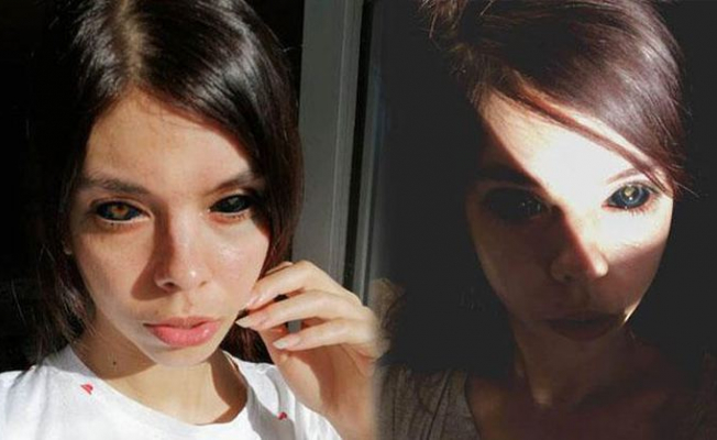 Gözünü Siyaha Boyamak İstedi! Görme Yetisini Kaybetti!