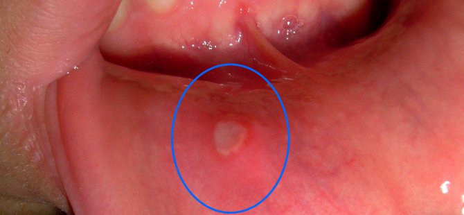 Ağzınızda Çıkan Bezelere Dikkat!