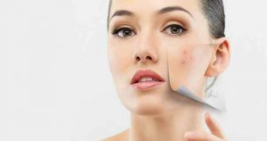 Yüzdeki benler nasıl geçer?