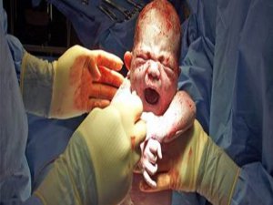 anneden bebeğe HIV geçişini önlemeyi başardı