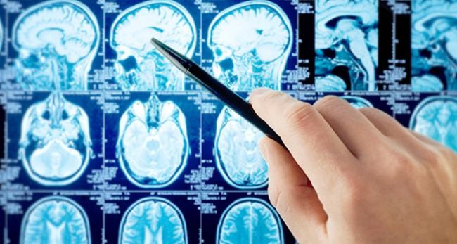 ALS hastalığı kimlerde görülür