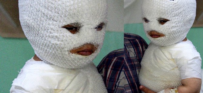 Ağrı'da Kaynar Süt Kazanına Düşerek Yanan Çocuk Erzurum'a Kaldırıldı