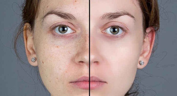 Cildinizdeki Lekeler Psikolojinizimi Bozuyor! Üzülmeyin İşte Çözüm