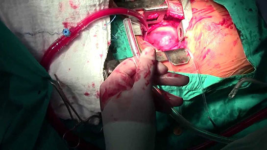 Kalp Durdurulmadan Kapakçık Değişimi