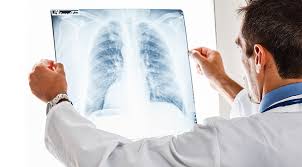 Akciğer kanseri erkeklerde en sık görülen kanser türü açıklandı ?