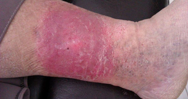 Varis ülseri nasıl tedavi edilir