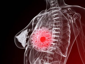 Her 4 Kadından Biri Meme Kanseri Oluyor! İşte Nedeni ve Sonuçlar