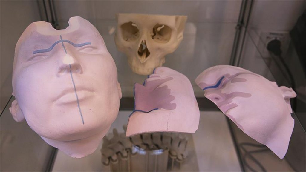 Titanyumdan Vücut Parçası Üretildi