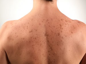 Ciltteki Lekeler Antibiyotikten Olabilir!