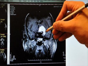 Kadın ve Erkek Beyinlerinin Karşılaştırılması