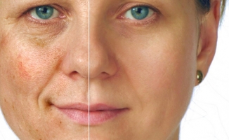 Cilt Lekelerinden Kurtulmak İstiyorsanız Sonbaharı Bekleyin