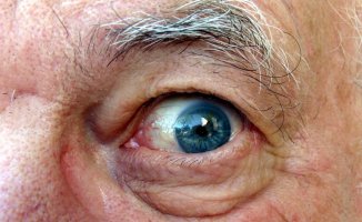 Göz Kapağı Sarkmasının Nedenleri