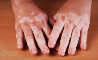Vitiligo Hastalığı Nedir? Nasıl Tedavi Edilir?