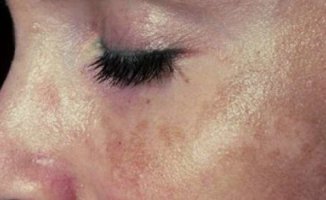 Güneş Lekesi Nedir? Güneş lekesinden kurtulma yolları