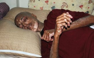 İlik Nakli Yapıldı Gözlerini Kaybetti!