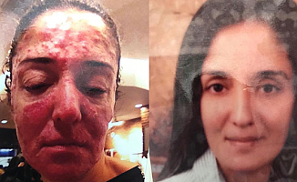 Çalışanının Kezzapla Bu hale getirdi!